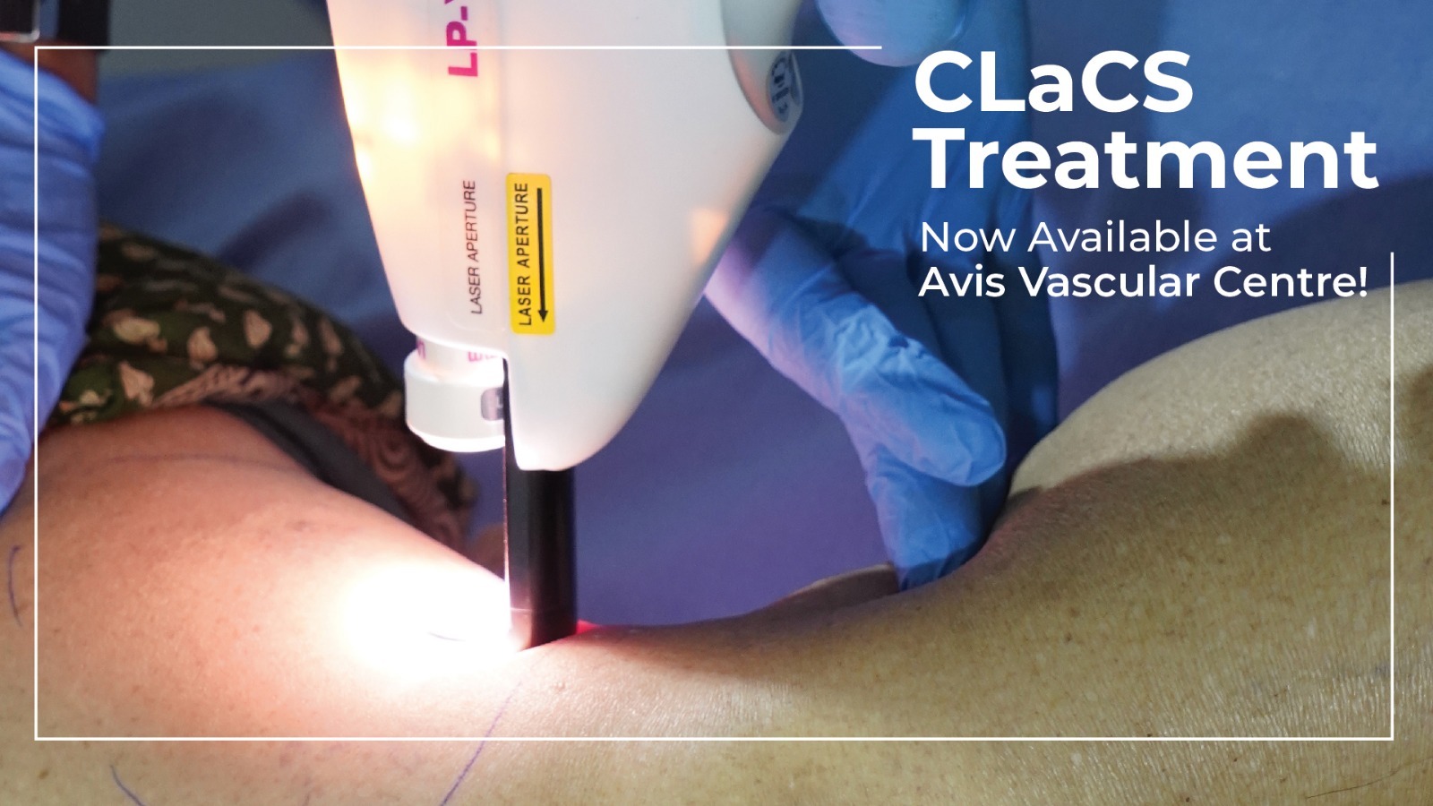 transforming-varicose-veins-synergy-clacs-ar-technology